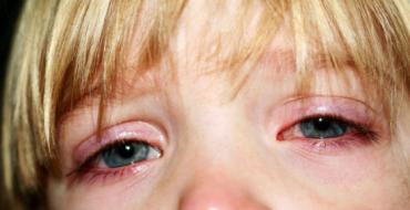 أعراض وعلاج ARVI عند الأطفال من مختلف الأعمار