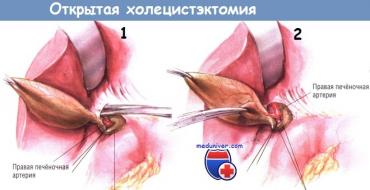 Laparotómia pooperačného obdobia žlčníka